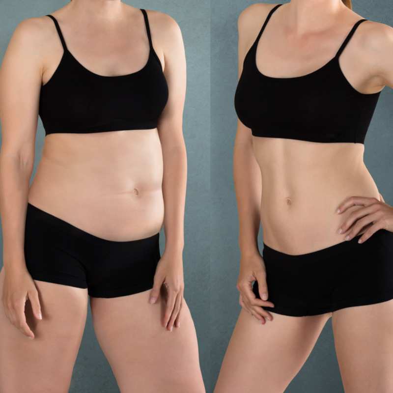 Does Fat Freezing at Home Work? DIY Devices vs Professional Cryolipolysis 2 before and after Cryolipolysis Southall