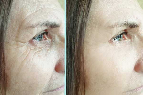 Why Do People Choose HIFU for a Non-Surgical Facelift? 4 How long can HIFU results last Southall?