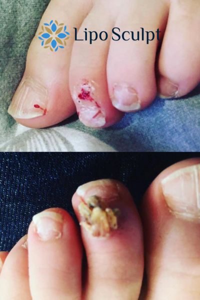 Wart removal customer results from Lipo Sculpt Southall